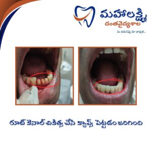 Business Name Mahalakshmi Dental Clinic | Best Dentist, Orthodontic , Dental Implant & Root Canal Centre in Khanapur - Nirmal - Adilabad Address: AMK Function Hall, Road, beside Katta Rajanna Oil Mill & Kirana store, beside Lucky Ladies Emporium, Khanapur, Telangana 504203 Phone: 9502211812,9502811812 Keywords: Mhalakshmi dental clinic in khanapur Mahalakshmi dental clinic in khanapur, Nirmal. Best dental clinics in Khanapur Best Dental Hospitals in Khanapur Top Dentists in Khanapur Best Endodontist Doctors in khanapur Best root canal doctor in khanapur Best maxillofacial surgeon in khanapur Best implantalogist in khanapur Best orthodontist in khanapur Dental hospital near me in khanapur Dental clinic near me in khanapur Top Dental clinic in Khanapur Best Dentist in Khanapur Best Root canal centre in khanapur Best Implant centre in khanapur Best Teeth cleaning clinic in khanapur Best Teeth Whitening clinic in khanapur Best Teeth Extraction clinic in khanapur Best Surgical Extraction clinic in khanapur Best Wisdom tooth Extraction clinic in khanapur Best cement filling clinic in khanapur Best children dental clinic in khanapur Best children dentist in khanapur Best Dental surgeon in khanapur Experienced dentist in khanapur Experienced dental clinic in khanapur Experienced root canal specialist in khanapur Best Root canal centre in khanapur Top Dental Services in khanapur Affordable Dental Implants in khanapur Root Canal Specialist in khanapur Teeth Whitening in khanapur Cosmetic Dentist in khanapur Orthodontistin khanapur Emergency Dental Care in khanapur Family Dentist in khanapur Pediatric Dentist in khanapur Gum Disease Treatment in khanapur clips treatment in khanapur Braces treatment in khanapur Dental Crown and Bridges Hanmakonda Smile Makeover in khanapur Dental Surgery in khanapur Wisdom Teeth Removal in khanapur Dental Implant Surgery in khanapur Dental Health Checkup in khanapur Porcelain Veneersin khanapur Sensitive Teeth Treatment in khanapur Dental Pain Relief in khanapur Dentures in khanapur Dental Fillings in khanapur Advanced Dental Care in khanapur Laser Dentistryin khanapur Dental Care for Seniors in khanapur Description: "Welcome to Mahalakshmi Dental Clinic Khanapur, your premier dental clinic in Khanapur 504203. We specialize in comprehensive dental treatments to ensure your oral health stays top-notch. From routine cleanings and dental check-ups to more advanced procedures like root canal treatments and tooth extractions, our expert team is dedicated to providing the highest standard of care. We also excel in restorative and cosmetic dentistry, helping you achieve a pearly white, confident smile. Using state-of-the-art technology and personalized care plans, Mahalakshmi Dental Clinic Khanapur is committed to your dental health. Visit us for professional, reliable, and affordable dental care in Khanapur ,Nirmal 504203." Facebook: https://www.facebook.com/mahalakshmidentalclinic/ https://www.facebook.com/mahalakshmidental/ Instagram: https://www.instagram.com/mahalakshmidental_khanapur/ THreads: https://www.threads.net/@mahalakshmidental_khanapur Youtube: https://www.youtube.com/@mahalakshmidentalclinic Website : https://mahalakshmidentalclinics.in/ telegram https://t.me/mahalakshmidentalclinic Google maps: https://www.google.com/maps/place/Mahalakshmi+Dental+Clinic+Khanapur+%7C+Best+Dental+Clinic,+Root+Canal+%26+Implant+Centre+in+Khanapur/@19.0407257,78.6510343,16z/data=!4m6!3m5!1s0x3bcd836b81589adb:0x92b6bc623dc1a56e!8m2!3d19.0401422!4d78.6504285!16s%2Fg%2F11vzs6bvmb?entry=ttu Shuru: https://shuru.co.in/services/dental-clinic-in-khanapur-nirmal