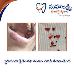 Business Name Mahalakshmi Dental Clinic | Best Dentist, Orthodontic , Dental Implant & Root Canal Centre in Khanapur - Nirmal - Adilabad Address: AMK Function Hall, Road, beside Katta Rajanna Oil Mill & Kirana store, beside Lucky Ladies Emporium, Khanapur, Telangana 504203 Phone: 9502211812,9502811812 Keywords: Mhalakshmi dental clinic in khanapur Mahalakshmi dental clinic in khanapur, Nirmal. Best dental clinics in Khanapur Best Dental Hospitals in Khanapur Top Dentists in Khanapur Best Endodontist Doctors in khanapur Best root canal doctor in khanapur Best maxillofacial surgeon in khanapur Best implantalogist in khanapur Best orthodontist in khanapur Dental hospital near me in khanapur Dental clinic near me in khanapur Top Dental clinic in Khanapur Best Dentist in Khanapur Best Root canal centre in khanapur Best Implant centre in khanapur Best Teeth cleaning clinic in khanapur Best Teeth Whitening clinic in khanapur Best Teeth Extraction clinic in khanapur Best Surgical Extraction clinic in khanapur Best Wisdom tooth Extraction clinic in khanapur Best cement filling clinic in khanapur Best children dental clinic in khanapur Best children dentist in khanapur Best Dental surgeon in khanapur Experienced dentist in khanapur Experienced dental clinic in khanapur Experienced root canal specialist in khanapur Best Root canal centre in khanapur Top Dental Services in khanapur Affordable Dental Implants in khanapur Root Canal Specialist in khanapur Teeth Whitening in khanapur Cosmetic Dentist in khanapur Orthodontistin khanapur Emergency Dental Care in khanapur Family Dentist in khanapur Pediatric Dentist in khanapur Gum Disease Treatment in khanapur clips treatment in khanapur Braces treatment in khanapur Dental Crown and Bridges Hanmakonda Smile Makeover in khanapur Dental Surgery in khanapur Wisdom Teeth Removal in khanapur Dental Implant Surgery in khanapur Dental Health Checkup in khanapur Porcelain Veneersin khanapur Sensitive Teeth Treatment in khanapur Dental Pain Relief in khanapur Dentures in khanapur Dental Fillings in khanapur Advanced Dental Care in khanapur Laser Dentistryin khanapur Dental Care for Seniors in khanapur Description: "Welcome to Mahalakshmi Dental Clinic Khanapur, your premier dental clinic in Khanapur 504203. We specialize in comprehensive dental treatments to ensure your oral health stays top-notch. From routine cleanings and dental check-ups to more advanced procedures like root canal treatments and tooth extractions, our expert team is dedicated to providing the highest standard of care. We also excel in restorative and cosmetic dentistry, helping you achieve a pearly white, confident smile. Using state-of-the-art technology and personalized care plans, Mahalakshmi Dental Clinic Khanapur is committed to your dental health. Visit us for professional, reliable, and affordable dental care in Khanapur ,Nirmal 504203." Facebook: https://www.facebook.com/mahalakshmidentalclinic/ https://www.facebook.com/mahalakshmidental/ Instagram: https://www.instagram.com/mahalakshmidental_khanapur/ THreads: https://www.threads.net/@mahalakshmidental_khanapur Youtube: https://www.youtube.com/@mahalakshmidentalclinic Website : https://mahalakshmidentalclinics.in/ telegram https://t.me/mahalakshmidentalclinic Google maps: https://www.google.com/maps/place/Mahalakshmi+Dental+Clinic+Khanapur+%7C+Best+Dental+Clinic,+Root+Canal+%26+Implant+Centre+in+Khanapur/@19.0407257,78.6510343,16z/data=!4m6!3m5!1s0x3bcd836b81589adb:0x92b6bc623dc1a56e!8m2!3d19.0401422!4d78.6504285!16s%2Fg%2F11vzs6bvmb?entry=ttu Shuru: https://shuru.co.in/services/dental-clinic-in-khanapur-nirmal