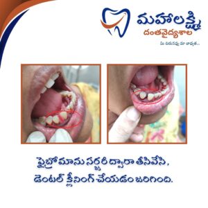 Business Name Mahalakshmi Dental Clinic | Best Dentist, Orthodontic , Dental Implant & Root Canal Centre in Khanapur - Nirmal - Adilabad Address: AMK Function Hall, Road, beside Katta Rajanna Oil Mill & Kirana store, beside Lucky Ladies Emporium, Khanapur, Telangana 504203 Phone: 9502211812,9502811812 Keywords: Mhalakshmi dental clinic in khanapur Mahalakshmi dental clinic in khanapur, Nirmal. Best dental clinics in Khanapur Best Dental Hospitals in Khanapur Top Dentists in Khanapur Best Endodontist Doctors in khanapur Best root canal doctor in khanapur Best maxillofacial surgeon in khanapur Best implantalogist in khanapur Best orthodontist in khanapur Dental hospital near me in khanapur Dental clinic near me in khanapur Top Dental clinic in Khanapur Best Dentist in Khanapur Best Root canal centre in khanapur Best Implant centre in khanapur Best Teeth cleaning clinic in khanapur Best Teeth Whitening clinic in khanapur Best Teeth Extraction clinic in khanapur Best Surgical Extraction clinic in khanapur Best Wisdom tooth Extraction clinic in khanapur Best cement filling clinic in khanapur Best children dental clinic in khanapur Best children dentist in khanapur Best Dental surgeon in khanapur Experienced dentist in khanapur Experienced dental clinic in khanapur Experienced root canal specialist in khanapur Best Root canal centre in khanapur Top Dental Services in khanapur Affordable Dental Implants in khanapur Root Canal Specialist in khanapur Teeth Whitening in khanapur Cosmetic Dentist in khanapur Orthodontistin khanapur Emergency Dental Care in khanapur Family Dentist in khanapur Pediatric Dentist in khanapur Gum Disease Treatment in khanapur clips treatment in khanapur Braces treatment in khanapur Dental Crown and Bridges Hanmakonda Smile Makeover in khanapur Dental Surgery in khanapur Wisdom Teeth Removal in khanapur Dental Implant Surgery in khanapur Dental Health Checkup in khanapur Porcelain Veneersin khanapur Sensitive Teeth Treatment in khanapur Dental Pain Relief in khanapur Dentures in khanapur Dental Fillings in khanapur Advanced Dental Care in khanapur Laser Dentistryin khanapur Dental Care for Seniors in khanapur Description: "Welcome to Mahalakshmi Dental Clinic Khanapur, your premier dental clinic in Khanapur 504203. We specialize in comprehensive dental treatments to ensure your oral health stays top-notch. From routine cleanings and dental check-ups to more advanced procedures like root canal treatments and tooth extractions, our expert team is dedicated to providing the highest standard of care. We also excel in restorative and cosmetic dentistry, helping you achieve a pearly white, confident smile. Using state-of-the-art technology and personalized care plans, Mahalakshmi Dental Clinic Khanapur is committed to your dental health. Visit us for professional, reliable, and affordable dental care in Khanapur ,Nirmal 504203." Facebook: https://www.facebook.com/mahalakshmidentalclinic/ https://www.facebook.com/mahalakshmidental/ Instagram: https://www.instagram.com/mahalakshmidental_khanapur/ THreads: https://www.threads.net/@mahalakshmidental_khanapur Youtube: https://www.youtube.com/@mahalakshmidentalclinic Website : https://mahalakshmidentalclinics.in/ telegram https://t.me/mahalakshmidentalclinic Google maps: https://www.google.com/maps/place/Mahalakshmi+Dental+Clinic+Khanapur+%7C+Best+Dental+Clinic,+Root+Canal+%26+Implant+Centre+in+Khanapur/@19.0407257,78.6510343,16z/data=!4m6!3m5!1s0x3bcd836b81589adb:0x92b6bc623dc1a56e!8m2!3d19.0401422!4d78.6504285!16s%2Fg%2F11vzs6bvmb?entry=ttu Shuru: https://shuru.co.in/services/dental-clinic-in-khanapur-nirmal