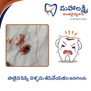 Business Name Mahalakshmi Dental Clinic | Best Dentist, Orthodontic , Dental Implant & Root Canal Centre in Khanapur - Nirmal - Adilabad Address: AMK Function Hall, Road, beside Katta Rajanna Oil Mill & Kirana store, beside Lucky Ladies Emporium, Khanapur, Telangana 504203 Phone: 9502211812,9502811812 Keywords: Mhalakshmi dental clinic in khanapur Mahalakshmi dental clinic in khanapur, Nirmal. Best dental clinics in Khanapur Best Dental Hospitals in Khanapur Top Dentists in Khanapur Best Endodontist Doctors in khanapur Best root canal doctor in khanapur Best maxillofacial surgeon in khanapur Best implantalogist in khanapur Best orthodontist in khanapur Dental hospital near me in khanapur Dental clinic near me in khanapur Top Dental clinic in Khanapur Best Dentist in Khanapur Best Root canal centre in khanapur Best Implant centre in khanapur Best Teeth cleaning clinic in khanapur Best Teeth Whitening clinic in khanapur Best Teeth Extraction clinic in khanapur Best Surgical Extraction clinic in khanapur Best Wisdom tooth Extraction clinic in khanapur Best cement filling clinic in khanapur Best children dental clinic in khanapur Best children dentist in khanapur Best Dental surgeon in khanapur Experienced dentist in khanapur Experienced dental clinic in khanapur Experienced root canal specialist in khanapur Best Root canal centre in khanapur Top Dental Services in khanapur Affordable Dental Implants in khanapur Root Canal Specialist in khanapur Teeth Whitening in khanapur Cosmetic Dentist in khanapur Orthodontistin khanapur Emergency Dental Care in khanapur Family Dentist in khanapur Pediatric Dentist in khanapur Gum Disease Treatment in khanapur clips treatment in khanapur Braces treatment in khanapur Dental Crown and Bridges Hanmakonda Smile Makeover in khanapur Dental Surgery in khanapur Wisdom Teeth Removal in khanapur Dental Implant Surgery in khanapur Dental Health Checkup in khanapur Porcelain Veneersin khanapur Sensitive Teeth Treatment in khanapur Dental Pain Relief in khanapur Dentures in khanapur Dental Fillings in khanapur Advanced Dental Care in khanapur Laser Dentistryin khanapur Dental Care for Seniors in khanapur Description: "Welcome to Mahalakshmi Dental Clinic Khanapur, your premier dental clinic in Khanapur 504203. We specialize in comprehensive dental treatments to ensure your oral health stays top-notch. From routine cleanings and dental check-ups to more advanced procedures like root canal treatments and tooth extractions, our expert team is dedicated to providing the highest standard of care. We also excel in restorative and cosmetic dentistry, helping you achieve a pearly white, confident smile. Using state-of-the-art technology and personalized care plans, Mahalakshmi Dental Clinic Khanapur is committed to your dental health. Visit us for professional, reliable, and affordable dental care in Khanapur ,Nirmal 504203." Facebook: https://www.facebook.com/mahalakshmidentalclinic/ https://www.facebook.com/mahalakshmidental/ Instagram: https://www.instagram.com/mahalakshmidental_khanapur/ THreads: https://www.threads.net/@mahalakshmidental_khanapur Youtube: https://www.youtube.com/@mahalakshmidentalclinic Website : https://mahalakshmidentalclinics.in/ telegram https://t.me/mahalakshmidentalclinic Google maps: https://www.google.com/maps/place/Mahalakshmi+Dental+Clinic+Khanapur+%7C+Best+Dental+Clinic,+Root+Canal+%26+Implant+Centre+in+Khanapur/@19.0407257,78.6510343,16z/data=!4m6!3m5!1s0x3bcd836b81589adb:0x92b6bc623dc1a56e!8m2!3d19.0401422!4d78.6504285!16s%2Fg%2F11vzs6bvmb?entry=ttu Shuru: https://shuru.co.in/services/dental-clinic-in-khanapur-nirmal