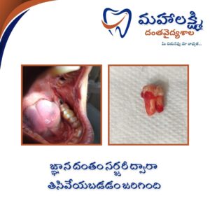 Business Name Mahalakshmi Dental Clinic | Best Dentist, Orthodontic , Dental Implant & Root Canal Centre in Khanapur - Nirmal - Adilabad Address: AMK Function Hall, Road, beside Katta Rajanna Oil Mill & Kirana store, beside Lucky Ladies Emporium, Khanapur, Telangana 504203 Phone: 9502211812,9502811812 Keywords: Mhalakshmi dental clinic in khanapur Mahalakshmi dental clinic in khanapur, Nirmal. Best dental clinics in Khanapur Best Dental Hospitals in Khanapur Top Dentists in Khanapur Best Endodontist Doctors in khanapur Best root canal doctor in khanapur Best maxillofacial surgeon in khanapur Best implantalogist in khanapur Best orthodontist in khanapur Dental hospital near me in khanapur Dental clinic near me in khanapur Top Dental clinic in Khanapur Best Dentist in Khanapur Best Root canal centre in khanapur Best Implant centre in khanapur Best Teeth cleaning clinic in khanapur Best Teeth Whitening clinic in khanapur Best Teeth Extraction clinic in khanapur Best Surgical Extraction clinic in khanapur Best Wisdom tooth Extraction clinic in khanapur Best cement filling clinic in khanapur Best children dental clinic in khanapur Best children dentist in khanapur Best Dental surgeon in khanapur Experienced dentist in khanapur Experienced dental clinic in khanapur Experienced root canal specialist in khanapur Best Root canal centre in khanapur Top Dental Services in khanapur Affordable Dental Implants in khanapur Root Canal Specialist in khanapur Teeth Whitening in khanapur Cosmetic Dentist in khanapur Orthodontistin khanapur Emergency Dental Care in khanapur Family Dentist in khanapur Pediatric Dentist in khanapur Gum Disease Treatment in khanapur clips treatment in khanapur Braces treatment in khanapur Dental Crown and Bridges Hanmakonda Smile Makeover in khanapur Dental Surgery in khanapur Wisdom Teeth Removal in khanapur Dental Implant Surgery in khanapur Dental Health Checkup in khanapur Porcelain Veneersin khanapur Sensitive Teeth Treatment in khanapur Dental Pain Relief in khanapur Dentures in khanapur Dental Fillings in khanapur Advanced Dental Care in khanapur Laser Dentistryin khanapur Dental Care for Seniors in khanapur Description: "Welcome to Mahalakshmi Dental Clinic Khanapur, your premier dental clinic in Khanapur 504203. We specialize in comprehensive dental treatments to ensure your oral health stays top-notch. From routine cleanings and dental check-ups to more advanced procedures like root canal treatments and tooth extractions, our expert team is dedicated to providing the highest standard of care. We also excel in restorative and cosmetic dentistry, helping you achieve a pearly white, confident smile. Using state-of-the-art technology and personalized care plans, Mahalakshmi Dental Clinic Khanapur is committed to your dental health. Visit us for professional, reliable, and affordable dental care in Khanapur ,Nirmal 504203." Facebook: https://www.facebook.com/mahalakshmidentalclinic/ https://www.facebook.com/mahalakshmidental/ Instagram: https://www.instagram.com/mahalakshmidental_khanapur/ THreads: https://www.threads.net/@mahalakshmidental_khanapur Youtube: https://www.youtube.com/@mahalakshmidentalclinic Website : https://mahalakshmidentalclinics.in/ telegram https://t.me/mahalakshmidentalclinic Google maps: https://www.google.com/maps/place/Mahalakshmi+Dental+Clinic+Khanapur+%7C+Best+Dental+Clinic,+Root+Canal+%26+Implant+Centre+in+Khanapur/@19.0407257,78.6510343,16z/data=!4m6!3m5!1s0x3bcd836b81589adb:0x92b6bc623dc1a56e!8m2!3d19.0401422!4d78.6504285!16s%2Fg%2F11vzs6bvmb?entry=ttu Shuru: https://shuru.co.in/services/dental-clinic-in-khanapur-nirmal