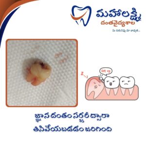 Business Name Mahalakshmi Dental Clinic | Best Dentist, Orthodontic , Dental Implant & Root Canal Centre in Khanapur - Nirmal - Adilabad Address: AMK Function Hall, Road, beside Katta Rajanna Oil Mill & Kirana store, beside Lucky Ladies Emporium, Khanapur, Telangana 504203 Phone: 9502211812,9502811812 Keywords: Mhalakshmi dental clinic in khanapur Mahalakshmi dental clinic in khanapur, Nirmal. Best dental clinics in Khanapur Best Dental Hospitals in Khanapur Top Dentists in Khanapur Best Endodontist Doctors in khanapur Best root canal doctor in khanapur Best maxillofacial surgeon in khanapur Best implantalogist in khanapur Best orthodontist in khanapur Dental hospital near me in khanapur Dental clinic near me in khanapur Top Dental clinic in Khanapur Best Dentist in Khanapur Best Root canal centre in khanapur Best Implant centre in khanapur Best Teeth cleaning clinic in khanapur Best Teeth Whitening clinic in khanapur Best Teeth Extraction clinic in khanapur Best Surgical Extraction clinic in khanapur Best Wisdom tooth Extraction clinic in khanapur Best cement filling clinic in khanapur Best children dental clinic in khanapur Best children dentist in khanapur Best Dental surgeon in khanapur Experienced dentist in khanapur Experienced dental clinic in khanapur Experienced root canal specialist in khanapur Best Root canal centre in khanapur Top Dental Services in khanapur Affordable Dental Implants in khanapur Root Canal Specialist in khanapur Teeth Whitening in khanapur Cosmetic Dentist in khanapur Orthodontistin khanapur Emergency Dental Care in khanapur Family Dentist in khanapur Pediatric Dentist in khanapur Gum Disease Treatment in khanapur clips treatment in khanapur Braces treatment in khanapur Dental Crown and Bridges Hanmakonda Smile Makeover in khanapur Dental Surgery in khanapur Wisdom Teeth Removal in khanapur Dental Implant Surgery in khanapur Dental Health Checkup in khanapur Porcelain Veneersin khanapur Sensitive Teeth Treatment in khanapur Dental Pain Relief in khanapur Dentures in khanapur Dental Fillings in khanapur Advanced Dental Care in khanapur Laser Dentistryin khanapur Dental Care for Seniors in khanapur Description: "Welcome to Mahalakshmi Dental Clinic Khanapur, your premier dental clinic in Khanapur 504203. We specialize in comprehensive dental treatments to ensure your oral health stays top-notch. From routine cleanings and dental check-ups to more advanced procedures like root canal treatments and tooth extractions, our expert team is dedicated to providing the highest standard of care. We also excel in restorative and cosmetic dentistry, helping you achieve a pearly white, confident smile. Using state-of-the-art technology and personalized care plans, Mahalakshmi Dental Clinic Khanapur is committed to your dental health. Visit us for professional, reliable, and affordable dental care in Khanapur ,Nirmal 504203." Facebook: https://www.facebook.com/mahalakshmidentalclinic/ https://www.facebook.com/mahalakshmidental/ Instagram: https://www.instagram.com/mahalakshmidental_khanapur/ THreads: https://www.threads.net/@mahalakshmidental_khanapur Youtube: https://www.youtube.com/@mahalakshmidentalclinic Website : https://mahalakshmidentalclinics.in/ telegram https://t.me/mahalakshmidentalclinic Google maps: https://www.google.com/maps/place/Mahalakshmi+Dental+Clinic+Khanapur+%7C+Best+Dental+Clinic,+Root+Canal+%26+Implant+Centre+in+Khanapur/@19.0407257,78.6510343,16z/data=!4m6!3m5!1s0x3bcd836b81589adb:0x92b6bc623dc1a56e!8m2!3d19.0401422!4d78.6504285!16s%2Fg%2F11vzs6bvmb?entry=ttu Shuru: https://shuru.co.in/services/dental-clinic-in-khanapur-nirmal