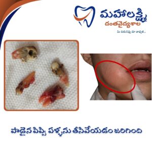 Business Name Mahalakshmi Dental Clinic | Best Dentist, Orthodontic , Dental Implant & Root Canal Centre in Khanapur - Nirmal - Adilabad Address: AMK Function Hall, Road, beside Katta Rajanna Oil Mill & Kirana store, beside Lucky Ladies Emporium, Khanapur, Telangana 504203 Phone: 9502211812,9502811812 Keywords: Mhalakshmi dental clinic in khanapur Mahalakshmi dental clinic in khanapur, Nirmal. Best dental clinics in Khanapur Best Dental Hospitals in Khanapur Top Dentists in Khanapur Best Endodontist Doctors in khanapur Best root canal doctor in khanapur Best maxillofacial surgeon in khanapur Best implantalogist in khanapur Best orthodontist in khanapur Dental hospital near me in khanapur Dental clinic near me in khanapur Top Dental clinic in Khanapur Best Dentist in Khanapur Best Root canal centre in khanapur Best Implant centre in khanapur Best Teeth cleaning clinic in khanapur Best Teeth Whitening clinic in khanapur Best Teeth Extraction clinic in khanapur Best Surgical Extraction clinic in khanapur Best Wisdom tooth Extraction clinic in khanapur Best cement filling clinic in khanapur Best children dental clinic in khanapur Best children dentist in khanapur Best Dental surgeon in khanapur Experienced dentist in khanapur Experienced dental clinic in khanapur Experienced root canal specialist in khanapur Best Root canal centre in khanapur Top Dental Services in khanapur Affordable Dental Implants in khanapur Root Canal Specialist in khanapur Teeth Whitening in khanapur Cosmetic Dentist in khanapur Orthodontistin khanapur Emergency Dental Care in khanapur Family Dentist in khanapur Pediatric Dentist in khanapur Gum Disease Treatment in khanapur clips treatment in khanapur Braces treatment in khanapur Dental Crown and Bridges Hanmakonda Smile Makeover in khanapur Dental Surgery in khanapur Wisdom Teeth Removal in khanapur Dental Implant Surgery in khanapur Dental Health Checkup in khanapur Porcelain Veneersin khanapur Sensitive Teeth Treatment in khanapur Dental Pain Relief in khanapur Dentures in khanapur Dental Fillings in khanapur Advanced Dental Care in khanapur Laser Dentistryin khanapur Dental Care for Seniors in khanapur Description: "Welcome to Mahalakshmi Dental Clinic Khanapur, your premier dental clinic in Khanapur 504203. We specialize in comprehensive dental treatments to ensure your oral health stays top-notch. From routine cleanings and dental check-ups to more advanced procedures like root canal treatments and tooth extractions, our expert team is dedicated to providing the highest standard of care. We also excel in restorative and cosmetic dentistry, helping you achieve a pearly white, confident smile. Using state-of-the-art technology and personalized care plans, Mahalakshmi Dental Clinic Khanapur is committed to your dental health. Visit us for professional, reliable, and affordable dental care in Khanapur ,Nirmal 504203." Facebook: https://www.facebook.com/mahalakshmidentalclinic/ https://www.facebook.com/mahalakshmidental/ Instagram: https://www.instagram.com/mahalakshmidental_khanapur/ THreads: https://www.threads.net/@mahalakshmidental_khanapur Youtube: https://www.youtube.com/@mahalakshmidentalclinic Website : https://mahalakshmidentalclinics.in/ telegram https://t.me/mahalakshmidentalclinic Google maps: https://www.google.com/maps/place/Mahalakshmi+Dental+Clinic+Khanapur+%7C+Best+Dental+Clinic,+Root+Canal+%26+Implant+Centre+in+Khanapur/@19.0407257,78.6510343,16z/data=!4m6!3m5!1s0x3bcd836b81589adb:0x92b6bc623dc1a56e!8m2!3d19.0401422!4d78.6504285!16s%2Fg%2F11vzs6bvmb?entry=ttu Shuru: https://shuru.co.in/services/dental-clinic-in-khanapur-nirmal