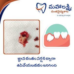 Business Name Mahalakshmi Dental Clinic | Best Dentist, Orthodontic , Dental Implant & Root Canal Centre in Khanapur - Nirmal - Adilabad Address: AMK Function Hall, Road, beside Katta Rajanna Oil Mill & Kirana store, beside Lucky Ladies Emporium, Khanapur, Telangana 504203 Phone: 9502211812,9502811812 Keywords: Mhalakshmi dental clinic in khanapur Mahalakshmi dental clinic in khanapur, Nirmal. Best dental clinics in Khanapur Best Dental Hospitals in Khanapur Top Dentists in Khanapur Best Endodontist Doctors in khanapur Best root canal doctor in khanapur Best maxillofacial surgeon in khanapur Best implantalogist in khanapur Best orthodontist in khanapur Dental hospital near me in khanapur Dental clinic near me in khanapur Top Dental clinic in Khanapur Best Dentist in Khanapur Best Root canal centre in khanapur Best Implant centre in khanapur Best Teeth cleaning clinic in khanapur Best Teeth Whitening clinic in khanapur Best Teeth Extraction clinic in khanapur Best Surgical Extraction clinic in khanapur Best Wisdom tooth Extraction clinic in khanapur Best cement filling clinic in khanapur Best children dental clinic in khanapur Best children dentist in khanapur Best Dental surgeon in khanapur Experienced dentist in khanapur Experienced dental clinic in khanapur Experienced root canal specialist in khanapur Best Root canal centre in khanapur Top Dental Services in khanapur Affordable Dental Implants in khanapur Root Canal Specialist in khanapur Teeth Whitening in khanapur Cosmetic Dentist in khanapur Orthodontistin khanapur Emergency Dental Care in khanapur Family Dentist in khanapur Pediatric Dentist in khanapur Gum Disease Treatment in khanapur clips treatment in khanapur Braces treatment in khanapur Dental Crown and Bridges Hanmakonda Smile Makeover in khanapur Dental Surgery in khanapur Wisdom Teeth Removal in khanapur Dental Implant Surgery in khanapur Dental Health Checkup in khanapur Porcelain Veneersin khanapur Sensitive Teeth Treatment in khanapur Dental Pain Relief in khanapur Dentures in khanapur Dental Fillings in khanapur Advanced Dental Care in khanapur Laser Dentistryin khanapur Dental Care for Seniors in khanapur Description: "Welcome to Mahalakshmi Dental Clinic Khanapur, your premier dental clinic in Khanapur 504203. We specialize in comprehensive dental treatments to ensure your oral health stays top-notch. From routine cleanings and dental check-ups to more advanced procedures like root canal treatments and tooth extractions, our expert team is dedicated to providing the highest standard of care. We also excel in restorative and cosmetic dentistry, helping you achieve a pearly white, confident smile. Using state-of-the-art technology and personalized care plans, Mahalakshmi Dental Clinic Khanapur is committed to your dental health. Visit us for professional, reliable, and affordable dental care in Khanapur ,Nirmal 504203." Facebook: https://www.facebook.com/mahalakshmidentalclinic/ https://www.facebook.com/mahalakshmidental/ Instagram: https://www.instagram.com/mahalakshmidental_khanapur/ THreads: https://www.threads.net/@mahalakshmidental_khanapur Youtube: https://www.youtube.com/@mahalakshmidentalclinic Website : https://mahalakshmidentalclinics.in/ telegram https://t.me/mahalakshmidentalclinic Google maps: https://www.google.com/maps/place/Mahalakshmi+Dental+Clinic+Khanapur+%7C+Best+Dental+Clinic,+Root+Canal+%26+Implant+Centre+in+Khanapur/@19.0407257,78.6510343,16z/data=!4m6!3m5!1s0x3bcd836b81589adb:0x92b6bc623dc1a56e!8m2!3d19.0401422!4d78.6504285!16s%2Fg%2F11vzs6bvmb?entry=ttu Shuru: https://shuru.co.in/services/dental-clinic-in-khanapur-nirmal