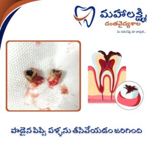 Business Name Mahalakshmi Dental Clinic | Best Dentist, Orthodontic , Dental Implant & Root Canal Centre in Khanapur - Nirmal - Adilabad Address: AMK Function Hall, Road, beside Katta Rajanna Oil Mill & Kirana store, beside Lucky Ladies Emporium, Khanapur, Telangana 504203 Phone: 9502211812,9502811812 Keywords: Mhalakshmi dental clinic in khanapur Mahalakshmi dental clinic in khanapur, Nirmal. Best dental clinics in Khanapur Best Dental Hospitals in Khanapur Top Dentists in Khanapur Best Endodontist Doctors in khanapur Best root canal doctor in khanapur Best maxillofacial surgeon in khanapur Best implantalogist in khanapur Best orthodontist in khanapur Dental hospital near me in khanapur Dental clinic near me in khanapur Top Dental clinic in Khanapur Best Dentist in Khanapur Best Root canal centre in khanapur Best Implant centre in khanapur Best Teeth cleaning clinic in khanapur Best Teeth Whitening clinic in khanapur Best Teeth Extraction clinic in khanapur Best Surgical Extraction clinic in khanapur Best Wisdom tooth Extraction clinic in khanapur Best cement filling clinic in khanapur Best children dental clinic in khanapur Best children dentist in khanapur Best Dental surgeon in khanapur Experienced dentist in khanapur Experienced dental clinic in khanapur Experienced root canal specialist in khanapur Best Root canal centre in khanapur Top Dental Services in khanapur Affordable Dental Implants in khanapur Root Canal Specialist in khanapur Teeth Whitening in khanapur Cosmetic Dentist in khanapur Orthodontistin khanapur Emergency Dental Care in khanapur Family Dentist in khanapur Pediatric Dentist in khanapur Gum Disease Treatment in khanapur clips treatment in khanapur Braces treatment in khanapur Dental Crown and Bridges Hanmakonda Smile Makeover in khanapur Dental Surgery in khanapur Wisdom Teeth Removal in khanapur Dental Implant Surgery in khanapur Dental Health Checkup in khanapur Porcelain Veneersin khanapur Sensitive Teeth Treatment in khanapur Dental Pain Relief in khanapur Dentures in khanapur Dental Fillings in khanapur Advanced Dental Care in khanapur Laser Dentistryin khanapur Dental Care for Seniors in khanapur Description: "Welcome to Mahalakshmi Dental Clinic Khanapur, your premier dental clinic in Khanapur 504203. We specialize in comprehensive dental treatments to ensure your oral health stays top-notch. From routine cleanings and dental check-ups to more advanced procedures like root canal treatments and tooth extractions, our expert team is dedicated to providing the highest standard of care. We also excel in restorative and cosmetic dentistry, helping you achieve a pearly white, confident smile. Using state-of-the-art technology and personalized care plans, Mahalakshmi Dental Clinic Khanapur is committed to your dental health. Visit us for professional, reliable, and affordable dental care in Khanapur ,Nirmal 504203." Facebook: https://www.facebook.com/mahalakshmidentalclinic/ https://www.facebook.com/mahalakshmidental/ Instagram: https://www.instagram.com/mahalakshmidental_khanapur/ THreads: https://www.threads.net/@mahalakshmidental_khanapur Youtube: https://www.youtube.com/@mahalakshmidentalclinic Website : https://mahalakshmidentalclinics.in/ telegram https://t.me/mahalakshmidentalclinic Google maps: https://www.google.com/maps/place/Mahalakshmi+Dental+Clinic+Khanapur+%7C+Best+Dental+Clinic,+Root+Canal+%26+Implant+Centre+in+Khanapur/@19.0407257,78.6510343,16z/data=!4m6!3m5!1s0x3bcd836b81589adb:0x92b6bc623dc1a56e!8m2!3d19.0401422!4d78.6504285!16s%2Fg%2F11vzs6bvmb?entry=ttu Shuru: https://shuru.co.in/services/dental-clinic-in-khanapur-nirmal