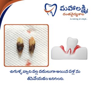 Business Name Mahalakshmi Dental Clinic | Best Dentist, Orthodontic , Dental Implant & Root Canal Centre in Khanapur - Nirmal - Adilabad Address: AMK Function Hall, Road, beside Katta Rajanna Oil Mill & Kirana store, beside Lucky Ladies Emporium, Khanapur, Telangana 504203 Phone: 9502211812,9502811812 Keywords: Mhalakshmi dental clinic in khanapur Mahalakshmi dental clinic in khanapur, Nirmal. Best dental clinics in Khanapur Best Dental Hospitals in Khanapur Top Dentists in Khanapur Best Endodontist Doctors in khanapur Best root canal doctor in khanapur Best maxillofacial surgeon in khanapur Best implantalogist in khanapur Best orthodontist in khanapur Dental hospital near me in khanapur Dental clinic near me in khanapur Top Dental clinic in Khanapur Best Dentist in Khanapur Best Root canal centre in khanapur Best Implant centre in khanapur Best Teeth cleaning clinic in khanapur Best Teeth Whitening clinic in khanapur Best Teeth Extraction clinic in khanapur Best Surgical Extraction clinic in khanapur Best Wisdom tooth Extraction clinic in khanapur Best cement filling clinic in khanapur Best children dental clinic in khanapur Best children dentist in khanapur Best Dental surgeon in khanapur Experienced dentist in khanapur Experienced dental clinic in khanapur Experienced root canal specialist in khanapur Best Root canal centre in khanapur Top Dental Services in khanapur Affordable Dental Implants in khanapur Root Canal Specialist in khanapur Teeth Whitening in khanapur Cosmetic Dentist in khanapur Orthodontistin khanapur Emergency Dental Care in khanapur Family Dentist in khanapur Pediatric Dentist in khanapur Gum Disease Treatment in khanapur clips treatment in khanapur Braces treatment in khanapur Dental Crown and Bridges Hanmakonda Smile Makeover in khanapur Dental Surgery in khanapur Wisdom Teeth Removal in khanapur Dental Implant Surgery in khanapur Dental Health Checkup in khanapur Porcelain Veneersin khanapur Sensitive Teeth Treatment in khanapur Dental Pain Relief in khanapur Dentures in khanapur Dental Fillings in khanapur Advanced Dental Care in khanapur Laser Dentistryin khanapur Dental Care for Seniors in khanapur Description: "Welcome to Mahalakshmi Dental Clinic Khanapur, your premier dental clinic in Khanapur 504203. We specialize in comprehensive dental treatments to ensure your oral health stays top-notch. From routine cleanings and dental check-ups to more advanced procedures like root canal treatments and tooth extractions, our expert team is dedicated to providing the highest standard of care. We also excel in restorative and cosmetic dentistry, helping you achieve a pearly white, confident smile. Using state-of-the-art technology and personalized care plans, Mahalakshmi Dental Clinic Khanapur is committed to your dental health. Visit us for professional, reliable, and affordable dental care in Khanapur ,Nirmal 504203." Facebook: https://www.facebook.com/mahalakshmidentalclinic/ https://www.facebook.com/mahalakshmidental/ Instagram: https://www.instagram.com/mahalakshmidental_khanapur/ THreads: https://www.threads.net/@mahalakshmidental_khanapur Youtube: https://www.youtube.com/@mahalakshmidentalclinic Website : https://mahalakshmidentalclinics.in/ telegram https://t.me/mahalakshmidentalclinic Google maps: https://www.google.com/maps/place/Mahalakshmi+Dental+Clinic+Khanapur+%7C+Best+Dental+Clinic,+Root+Canal+%26+Implant+Centre+in+Khanapur/@19.0407257,78.6510343,16z/data=!4m6!3m5!1s0x3bcd836b81589adb:0x92b6bc623dc1a56e!8m2!3d19.0401422!4d78.6504285!16s%2Fg%2F11vzs6bvmb?entry=ttu Shuru: https://shuru.co.in/services/dental-clinic-in-khanapur-nirmal