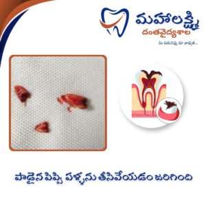 Business Name Mahalakshmi Dental Clinic | Best Dentist, Orthodontic , Dental Implant & Root Canal Centre in Khanapur - Nirmal - Adilabad Address: AMK Function Hall, Road, beside Katta Rajanna Oil Mill & Kirana store, beside Lucky Ladies Emporium, Khanapur, Telangana 504203 Phone: 9502211812,9502811812 Keywords: Mhalakshmi dental clinic in khanapur Mahalakshmi dental clinic in khanapur, Nirmal. Best dental clinics in Khanapur Best Dental Hospitals in Khanapur Top Dentists in Khanapur Best Endodontist Doctors in khanapur Best root canal doctor in khanapur Best maxillofacial surgeon in khanapur Best implantalogist in khanapur Best orthodontist in khanapur Dental hospital near me in khanapur Dental clinic near me in khanapur Top Dental clinic in Khanapur Best Dentist in Khanapur Best Root canal centre in khanapur Best Implant centre in khanapur Best Teeth cleaning clinic in khanapur Best Teeth Whitening clinic in khanapur Best Teeth Extraction clinic in khanapur Best Surgical Extraction clinic in khanapur Best Wisdom tooth Extraction clinic in khanapur Best cement filling clinic in khanapur Best children dental clinic in khanapur Best children dentist in khanapur Best Dental surgeon in khanapur Experienced dentist in khanapur Experienced dental clinic in khanapur Experienced root canal specialist in khanapur Best Root canal centre in khanapur Top Dental Services in khanapur Affordable Dental Implants in khanapur Root Canal Specialist in khanapur Teeth Whitening in khanapur Cosmetic Dentist in khanapur Orthodontistin khanapur Emergency Dental Care in khanapur Family Dentist in khanapur Pediatric Dentist in khanapur Gum Disease Treatment in khanapur clips treatment in khanapur Braces treatment in khanapur Dental Crown and Bridges Hanmakonda Smile Makeover in khanapur Dental Surgery in khanapur Wisdom Teeth Removal in khanapur Dental Implant Surgery in khanapur Dental Health Checkup in khanapur Porcelain Veneersin khanapur Sensitive Teeth Treatment in khanapur Dental Pain Relief in khanapur Dentures in khanapur Dental Fillings in khanapur Advanced Dental Care in khanapur Laser Dentistryin khanapur Dental Care for Seniors in khanapur Description: "Welcome to Mahalakshmi Dental Clinic Khanapur, your premier dental clinic in Khanapur 504203. We specialize in comprehensive dental treatments to ensure your oral health stays top-notch. From routine cleanings and dental check-ups to more advanced procedures like root canal treatments and tooth extractions, our expert team is dedicated to providing the highest standard of care. We also excel in restorative and cosmetic dentistry, helping you achieve a pearly white, confident smile. Using state-of-the-art technology and personalized care plans, Mahalakshmi Dental Clinic Khanapur is committed to your dental health. Visit us for professional, reliable, and affordable dental care in Khanapur ,Nirmal 504203." Facebook: https://www.facebook.com/mahalakshmidentalclinic/ https://www.facebook.com/mahalakshmidental/ Instagram: https://www.instagram.com/mahalakshmidental_khanapur/ THreads: https://www.threads.net/@mahalakshmidental_khanapur Youtube: https://www.youtube.com/@mahalakshmidentalclinic Website : https://mahalakshmidentalclinics.in/ telegram https://t.me/mahalakshmidentalclinic Google maps: https://www.google.com/maps/place/Mahalakshmi+Dental+Clinic+Khanapur+%7C+Best+Dental+Clinic,+Root+Canal+%26+Implant+Centre+in+Khanapur/@19.0407257,78.6510343,16z/data=!4m6!3m5!1s0x3bcd836b81589adb:0x92b6bc623dc1a56e!8m2!3d19.0401422!4d78.6504285!16s%2Fg%2F11vzs6bvmb?entry=ttu Shuru: https://shuru.co.in/services/dental-clinic-in-khanapur-nirmal