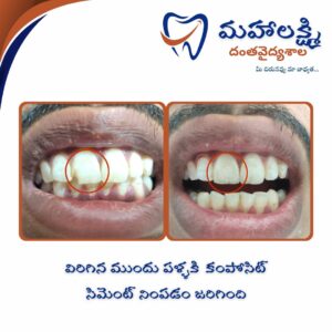 Business Name Mahalakshmi Dental Clinic | Best Dentist, Orthodontic , Dental Implant & Root Canal Centre in Khanapur - Nirmal - Adilabad Address: AMK Function Hall, Road, beside Katta Rajanna Oil Mill & Kirana store, beside Lucky Ladies Emporium, Khanapur, Telangana 504203 Phone: 9502211812,9502811812 Keywords: Mhalakshmi dental clinic in khanapur Mahalakshmi dental clinic in khanapur, Nirmal. Best dental clinics in Khanapur Best Dental Hospitals in Khanapur Top Dentists in Khanapur Best Endodontist Doctors in khanapur Best root canal doctor in khanapur Best maxillofacial surgeon in khanapur Best implantalogist in khanapur Best orthodontist in khanapur Dental hospital near me in khanapur Dental clinic near me in khanapur Top Dental clinic in Khanapur Best Dentist in Khanapur Best Root canal centre in khanapur Best Implant centre in khanapur Best Teeth cleaning clinic in khanapur Best Teeth Whitening clinic in khanapur Best Teeth Extraction clinic in khanapur Best Surgical Extraction clinic in khanapur Best Wisdom tooth Extraction clinic in khanapur Best cement filling clinic in khanapur Best children dental clinic in khanapur Best children dentist in khanapur Best Dental surgeon in khanapur Experienced dentist in khanapur Experienced dental clinic in khanapur Experienced root canal specialist in khanapur Best Root canal centre in khanapur Top Dental Services in khanapur Affordable Dental Implants in khanapur Root Canal Specialist in khanapur Teeth Whitening in khanapur Cosmetic Dentist in khanapur Orthodontistin khanapur Emergency Dental Care in khanapur Family Dentist in khanapur Pediatric Dentist in khanapur Gum Disease Treatment in khanapur clips treatment in khanapur Braces treatment in khanapur Dental Crown and Bridges Hanmakonda Smile Makeover in khanapur Dental Surgery in khanapur Wisdom Teeth Removal in khanapur Dental Implant Surgery in khanapur Dental Health Checkup in khanapur Porcelain Veneersin khanapur Sensitive Teeth Treatment in khanapur Dental Pain Relief in khanapur Dentures in khanapur Dental Fillings in khanapur Advanced Dental Care in khanapur Laser Dentistryin khanapur Dental Care for Seniors in khanapur Description: "Welcome to Mahalakshmi Dental Clinic Khanapur, your premier dental clinic in Khanapur 504203. We specialize in comprehensive dental treatments to ensure your oral health stays top-notch. From routine cleanings and dental check-ups to more advanced procedures like root canal treatments and tooth extractions, our expert team is dedicated to providing the highest standard of care. We also excel in restorative and cosmetic dentistry, helping you achieve a pearly white, confident smile. Using state-of-the-art technology and personalized care plans, Mahalakshmi Dental Clinic Khanapur is committed to your dental health. Visit us for professional, reliable, and affordable dental care in Khanapur ,Nirmal 504203." Facebook: https://www.facebook.com/mahalakshmidentalclinic/ https://www.facebook.com/mahalakshmidental/ Instagram: https://www.instagram.com/mahalakshmidental_khanapur/ THreads: https://www.threads.net/@mahalakshmidental_khanapur Youtube: https://www.youtube.com/@mahalakshmidentalclinic Website : https://mahalakshmidentalclinics.in/ telegram https://t.me/mahalakshmidentalclinic Google maps: https://www.google.com/maps/place/Mahalakshmi+Dental+Clinic+Khanapur+%7C+Best+Dental+Clinic,+Root+Canal+%26+Implant+Centre+in+Khanapur/@19.0407257,78.6510343,16z/data=!4m6!3m5!1s0x3bcd836b81589adb:0x92b6bc623dc1a56e!8m2!3d19.0401422!4d78.6504285!16s%2Fg%2F11vzs6bvmb?entry=ttu Shuru: https://shuru.co.in/services/dental-clinic-in-khanapur-nirmal