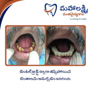 Business Name Mahalakshmi Dental Clinic | Best Dentist, Orthodontic , Dental Implant & Root Canal Centre in Khanapur - Nirmal - Adilabad Address: AMK Function Hall, Road, beside Katta Rajanna Oil Mill & Kirana store, beside Lucky Ladies Emporium, Khanapur, Telangana 504203 Phone: 9502211812,9502811812 Keywords: Mhalakshmi dental clinic in khanapur Mahalakshmi dental clinic in khanapur, Nirmal. Best dental clinics in Khanapur Best Dental Hospitals in Khanapur Top Dentists in Khanapur Best Endodontist Doctors in khanapur Best root canal doctor in khanapur Best maxillofacial surgeon in khanapur Best implantalogist in khanapur Best orthodontist in khanapur Dental hospital near me in khanapur Dental clinic near me in khanapur Top Dental clinic in Khanapur Best Dentist in Khanapur Best Root canal centre in khanapur Best Implant centre in khanapur Best Teeth cleaning clinic in khanapur Best Teeth Whitening clinic in khanapur Best Teeth Extraction clinic in khanapur Best Surgical Extraction clinic in khanapur Best Wisdom tooth Extraction clinic in khanapur Best cement filling clinic in khanapur Best children dental clinic in khanapur Best children dentist in khanapur Best Dental surgeon in khanapur Experienced dentist in khanapur Experienced dental clinic in khanapur Experienced root canal specialist in khanapur Best Root canal centre in khanapur Top Dental Services in khanapur Affordable Dental Implants in khanapur Root Canal Specialist in khanapur Teeth Whitening in khanapur Cosmetic Dentist in khanapur Orthodontistin khanapur Emergency Dental Care in khanapur Family Dentist in khanapur Pediatric Dentist in khanapur Gum Disease Treatment in khanapur clips treatment in khanapur Braces treatment in khanapur Dental Crown and Bridges Hanmakonda Smile Makeover in khanapur Dental Surgery in khanapur Wisdom Teeth Removal in khanapur Dental Implant Surgery in khanapur Dental Health Checkup in khanapur Porcelain Veneersin khanapur Sensitive Teeth Treatment in khanapur Dental Pain Relief in khanapur Dentures in khanapur Dental Fillings in khanapur Advanced Dental Care in khanapur Laser Dentistryin khanapur Dental Care for Seniors in khanapur Description: "Welcome to Mahalakshmi Dental Clinic Khanapur, your premier dental clinic in Khanapur 504203. We specialize in comprehensive dental treatments to ensure your oral health stays top-notch. From routine cleanings and dental check-ups to more advanced procedures like root canal treatments and tooth extractions, our expert team is dedicated to providing the highest standard of care. We also excel in restorative and cosmetic dentistry, helping you achieve a pearly white, confident smile. Using state-of-the-art technology and personalized care plans, Mahalakshmi Dental Clinic Khanapur is committed to your dental health. Visit us for professional, reliable, and affordable dental care in Khanapur ,Nirmal 504203." Facebook: https://www.facebook.com/mahalakshmidentalclinic/ https://www.facebook.com/mahalakshmidental/ Instagram: https://www.instagram.com/mahalakshmidental_khanapur/ THreads: https://www.threads.net/@mahalakshmidental_khanapur Youtube: https://www.youtube.com/@mahalakshmidentalclinic Website : https://mahalakshmidentalclinics.in/ telegram https://t.me/mahalakshmidentalclinic Google maps: https://www.google.com/maps/place/Mahalakshmi+Dental+Clinic+Khanapur+%7C+Best+Dental+Clinic,+Root+Canal+%26+Implant+Centre+in+Khanapur/@19.0407257,78.6510343,16z/data=!4m6!3m5!1s0x3bcd836b81589adb:0x92b6bc623dc1a56e!8m2!3d19.0401422!4d78.6504285!16s%2Fg%2F11vzs6bvmb?entry=ttu Shuru: https://shuru.co.in/services/dental-clinic-in-khanapur-nirmal