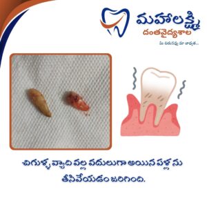 Business Name Mahalakshmi Dental Clinic | Best Dentist, Orthodontic , Dental Implant & Root Canal Centre in Khanapur - Nirmal - Adilabad Address: AMK Function Hall, Road, beside Katta Rajanna Oil Mill & Kirana store, beside Lucky Ladies Emporium, Khanapur, Telangana 504203 Phone: 9502211812,9502811812 Keywords: Mhalakshmi dental clinic in khanapur Mahalakshmi dental clinic in khanapur, Nirmal. Best dental clinics in Khanapur Best Dental Hospitals in Khanapur Top Dentists in Khanapur Best Endodontist Doctors in khanapur Best root canal doctor in khanapur Best maxillofacial surgeon in khanapur Best implantalogist in khanapur Best orthodontist in khanapur Dental hospital near me in khanapur Dental clinic near me in khanapur Top Dental clinic in Khanapur Best Dentist in Khanapur Best Root canal centre in khanapur Best Implant centre in khanapur Best Teeth cleaning clinic in khanapur Best Teeth Whitening clinic in khanapur Best Teeth Extraction clinic in khanapur Best Surgical Extraction clinic in khanapur Best Wisdom tooth Extraction clinic in khanapur Best cement filling clinic in khanapur Best children dental clinic in khanapur Best children dentist in khanapur Best Dental surgeon in khanapur Experienced dentist in khanapur Experienced dental clinic in khanapur Experienced root canal specialist in khanapur Best Root canal centre in khanapur Top Dental Services in khanapur Affordable Dental Implants in khanapur Root Canal Specialist in khanapur Teeth Whitening in khanapur Cosmetic Dentist in khanapur Orthodontistin khanapur Emergency Dental Care in khanapur Family Dentist in khanapur Pediatric Dentist in khanapur Gum Disease Treatment in khanapur clips treatment in khanapur Braces treatment in khanapur Dental Crown and Bridges Hanmakonda Smile Makeover in khanapur Dental Surgery in khanapur Wisdom Teeth Removal in khanapur Dental Implant Surgery in khanapur Dental Health Checkup in khanapur Porcelain Veneersin khanapur Sensitive Teeth Treatment in khanapur Dental Pain Relief in khanapur Dentures in khanapur Dental Fillings in khanapur Advanced Dental Care in khanapur Laser Dentistryin khanapur Dental Care for Seniors in khanapur Description: "Welcome to Mahalakshmi Dental Clinic Khanapur, your premier dental clinic in Khanapur 504203. We specialize in comprehensive dental treatments to ensure your oral health stays top-notch. From routine cleanings and dental check-ups to more advanced procedures like root canal treatments and tooth extractions, our expert team is dedicated to providing the highest standard of care. We also excel in restorative and cosmetic dentistry, helping you achieve a pearly white, confident smile. Using state-of-the-art technology and personalized care plans, Mahalakshmi Dental Clinic Khanapur is committed to your dental health. Visit us for professional, reliable, and affordable dental care in Khanapur ,Nirmal 504203." Facebook: https://www.facebook.com/mahalakshmidentalclinic/ https://www.facebook.com/mahalakshmidental/ Instagram: https://www.instagram.com/mahalakshmidental_khanapur/ THreads: https://www.threads.net/@mahalakshmidental_khanapur Youtube: https://www.youtube.com/@mahalakshmidentalclinic Website : https://mahalakshmidentalclinics.in/ telegram https://t.me/mahalakshmidentalclinic Google maps: https://www.google.com/maps/place/Mahalakshmi+Dental+Clinic+Khanapur+%7C+Best+Dental+Clinic,+Root+Canal+%26+Implant+Centre+in+Khanapur/@19.0407257,78.6510343,16z/data=!4m6!3m5!1s0x3bcd836b81589adb:0x92b6bc623dc1a56e!8m2!3d19.0401422!4d78.6504285!16s%2Fg%2F11vzs6bvmb?entry=ttu Shuru: https://shuru.co.in/services/dental-clinic-in-khanapur-nirmal