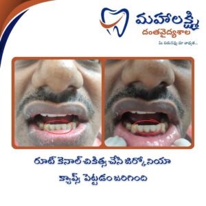 Business Name Mahalakshmi Dental Clinic | Best Dentist, Orthodontic , Dental Implant & Root Canal Centre in Khanapur - Nirmal - Adilabad Address: AMK Function Hall, Road, beside Katta Rajanna Oil Mill & Kirana store, beside Lucky Ladies Emporium, Khanapur, Telangana 504203 Phone: 9502211812,9502811812 Keywords: Mhalakshmi dental clinic in khanapur Mahalakshmi dental clinic in khanapur, Nirmal. Best dental clinics in Khanapur Best Dental Hospitals in Khanapur Top Dentists in Khanapur Best Endodontist Doctors in khanapur Best root canal doctor in khanapur Best maxillofacial surgeon in khanapur Best implantalogist in khanapur Best orthodontist in khanapur Dental hospital near me in khanapur Dental clinic near me in khanapur Top Dental clinic in Khanapur Best Dentist in Khanapur Best Root canal centre in khanapur Best Implant centre in khanapur Best Teeth cleaning clinic in khanapur Best Teeth Whitening clinic in khanapur Best Teeth Extraction clinic in khanapur Best Surgical Extraction clinic in khanapur Best Wisdom tooth Extraction clinic in khanapur Best cement filling clinic in khanapur Best children dental clinic in khanapur Best children dentist in khanapur Best Dental surgeon in khanapur Experienced dentist in khanapur Experienced dental clinic in khanapur Experienced root canal specialist in khanapur Best Root canal centre in khanapur Top Dental Services in khanapur Affordable Dental Implants in khanapur Root Canal Specialist in khanapur Teeth Whitening in khanapur Cosmetic Dentist in khanapur Orthodontistin khanapur Emergency Dental Care in khanapur Family Dentist in khanapur Pediatric Dentist in khanapur Gum Disease Treatment in khanapur clips treatment in khanapur Braces treatment in khanapur Dental Crown and Bridges Hanmakonda Smile Makeover in khanapur Dental Surgery in khanapur Wisdom Teeth Removal in khanapur Dental Implant Surgery in khanapur Dental Health Checkup in khanapur Porcelain Veneersin khanapur Sensitive Teeth Treatment in khanapur Dental Pain Relief in khanapur Dentures in khanapur Dental Fillings in khanapur Advanced Dental Care in khanapur Laser Dentistryin khanapur Dental Care for Seniors in khanapur Description: "Welcome to Mahalakshmi Dental Clinic Khanapur, your premier dental clinic in Khanapur 504203. We specialize in comprehensive dental treatments to ensure your oral health stays top-notch. From routine cleanings and dental check-ups to more advanced procedures like root canal treatments and tooth extractions, our expert team is dedicated to providing the highest standard of care. We also excel in restorative and cosmetic dentistry, helping you achieve a pearly white, confident smile. Using state-of-the-art technology and personalized care plans, Mahalakshmi Dental Clinic Khanapur is committed to your dental health. Visit us for professional, reliable, and affordable dental care in Khanapur ,Nirmal 504203." Facebook: https://www.facebook.com/mahalakshmidentalclinic/ https://www.facebook.com/mahalakshmidental/ Instagram: https://www.instagram.com/mahalakshmidental_khanapur/ THreads: https://www.threads.net/@mahalakshmidental_khanapur Youtube: https://www.youtube.com/@mahalakshmidentalclinic Website : https://mahalakshmidentalclinics.in/ telegram https://t.me/mahalakshmidentalclinic Google maps: https://www.google.com/maps/place/Mahalakshmi+Dental+Clinic+Khanapur+%7C+Best+Dental+Clinic,+Root+Canal+%26+Implant+Centre+in+Khanapur/@19.0407257,78.6510343,16z/data=!4m6!3m5!1s0x3bcd836b81589adb:0x92b6bc623dc1a56e!8m2!3d19.0401422!4d78.6504285!16s%2Fg%2F11vzs6bvmb?entry=ttu Shuru: https://shuru.co.in/services/dental-clinic-in-khanapur-nirmal