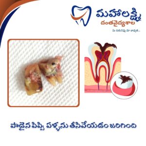 Business Name Mahalakshmi Dental Clinic | Best Dentist, Orthodontic , Dental Implant & Root Canal Centre in Khanapur - Nirmal - Adilabad Address: AMK Function Hall, Road, beside Katta Rajanna Oil Mill & Kirana store, beside Lucky Ladies Emporium, Khanapur, Telangana 504203 Phone: 9502211812,9502811812 Keywords: Mhalakshmi dental clinic in khanapur Mahalakshmi dental clinic in khanapur, Nirmal. Best dental clinics in Khanapur Best Dental Hospitals in Khanapur Top Dentists in Khanapur Best Endodontist Doctors in khanapur Best root canal doctor in khanapur Best maxillofacial surgeon in khanapur Best implantalogist in khanapur Best orthodontist in khanapur Dental hospital near me in khanapur Dental clinic near me in khanapur Top Dental clinic in Khanapur Best Dentist in Khanapur Best Root canal centre in khanapur Best Implant centre in khanapur Best Teeth cleaning clinic in khanapur Best Teeth Whitening clinic in khanapur Best Teeth Extraction clinic in khanapur Best Surgical Extraction clinic in khanapur Best Wisdom tooth Extraction clinic in khanapur Best cement filling clinic in khanapur Best children dental clinic in khanapur Best children dentist in khanapur Best Dental surgeon in khanapur Experienced dentist in khanapur Experienced dental clinic in khanapur Experienced root canal specialist in khanapur Best Root canal centre in khanapur Top Dental Services in khanapur Affordable Dental Implants in khanapur Root Canal Specialist in khanapur Teeth Whitening in khanapur Cosmetic Dentist in khanapur Orthodontistin khanapur Emergency Dental Care in khanapur Family Dentist in khanapur Pediatric Dentist in khanapur Gum Disease Treatment in khanapur clips treatment in khanapur Braces treatment in khanapur Dental Crown and Bridges Hanmakonda Smile Makeover in khanapur Dental Surgery in khanapur Wisdom Teeth Removal in khanapur Dental Implant Surgery in khanapur Dental Health Checkup in khanapur Porcelain Veneersin khanapur Sensitive Teeth Treatment in khanapur Dental Pain Relief in khanapur Dentures in khanapur Dental Fillings in khanapur Advanced Dental Care in khanapur Laser Dentistryin khanapur Dental Care for Seniors in khanapur Description: "Welcome to Mahalakshmi Dental Clinic Khanapur, your premier dental clinic in Khanapur 504203. We specialize in comprehensive dental treatments to ensure your oral health stays top-notch. From routine cleanings and dental check-ups to more advanced procedures like root canal treatments and tooth extractions, our expert team is dedicated to providing the highest standard of care. We also excel in restorative and cosmetic dentistry, helping you achieve a pearly white, confident smile. Using state-of-the-art technology and personalized care plans, Mahalakshmi Dental Clinic Khanapur is committed to your dental health. Visit us for professional, reliable, and affordable dental care in Khanapur ,Nirmal 504203." Facebook: https://www.facebook.com/mahalakshmidentalclinic/ https://www.facebook.com/mahalakshmidental/ Instagram: https://www.instagram.com/mahalakshmidental_khanapur/ THreads: https://www.threads.net/@mahalakshmidental_khanapur Youtube: https://www.youtube.com/@mahalakshmidentalclinic Website : https://mahalakshmidentalclinics.in/ telegram https://t.me/mahalakshmidentalclinic Google maps: https://www.google.com/maps/place/Mahalakshmi+Dental+Clinic+Khanapur+%7C+Best+Dental+Clinic,+Root+Canal+%26+Implant+Centre+in+Khanapur/@19.0407257,78.6510343,16z/data=!4m6!3m5!1s0x3bcd836b81589adb:0x92b6bc623dc1a56e!8m2!3d19.0401422!4d78.6504285!16s%2Fg%2F11vzs6bvmb?entry=ttu Shuru: https://shuru.co.in/services/dental-clinic-in-khanapur-nirmal